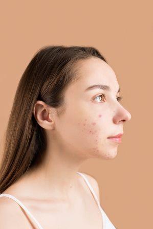 Acne scar Removal