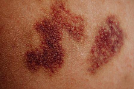 Psoriasis Signs and symptoms