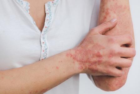 Living with Psoriasis